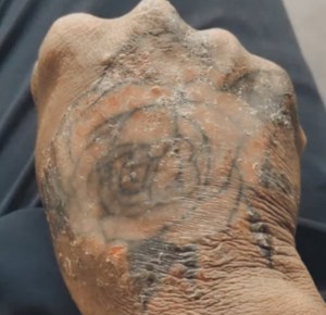 long-term-effects-on-skin-of-using-pen-ink